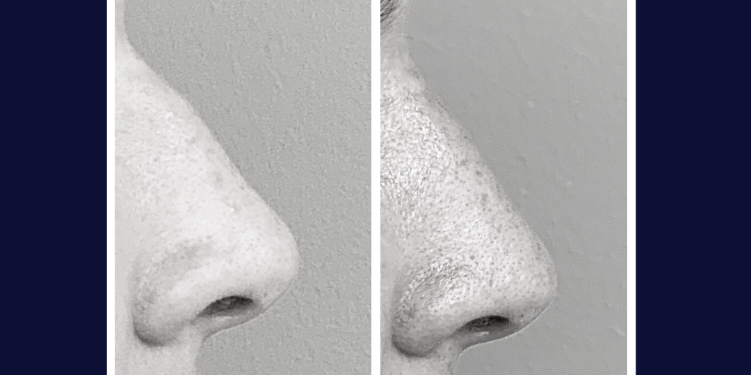 rhinoplastie chirurgie du nez dijon