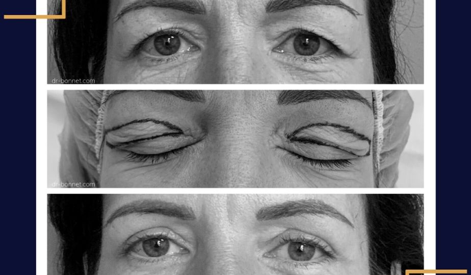 chirurgie des paupières dijon blépharoplastie